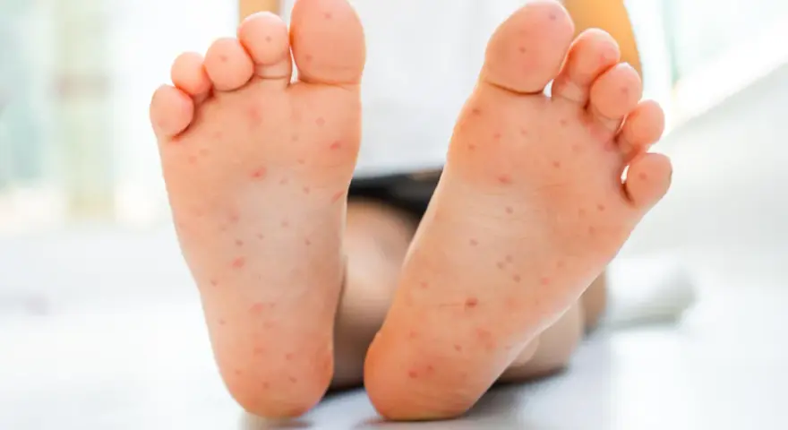 Piedi di bambino con eruzione cutanea, possibile contagio mani bocca. I genitori preoccupati cercano risposte.