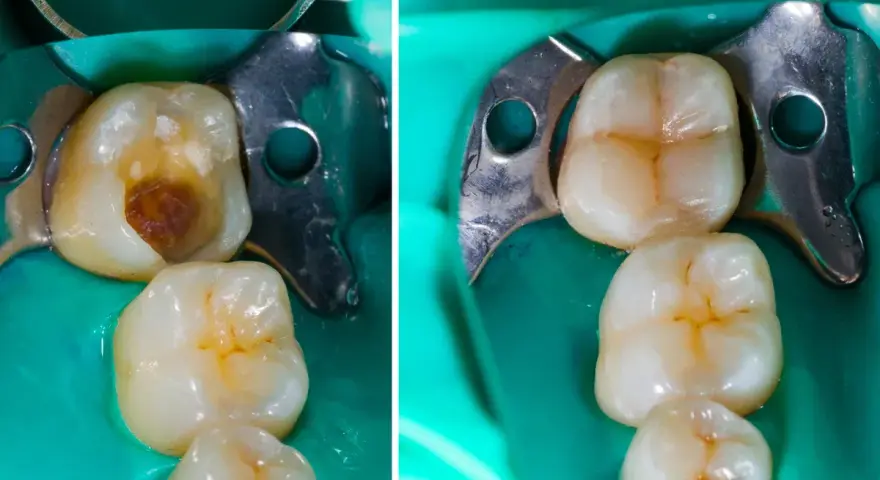 Prima e dopo: un dente con carie profonda e il suo ripristino con otturazione estetica.