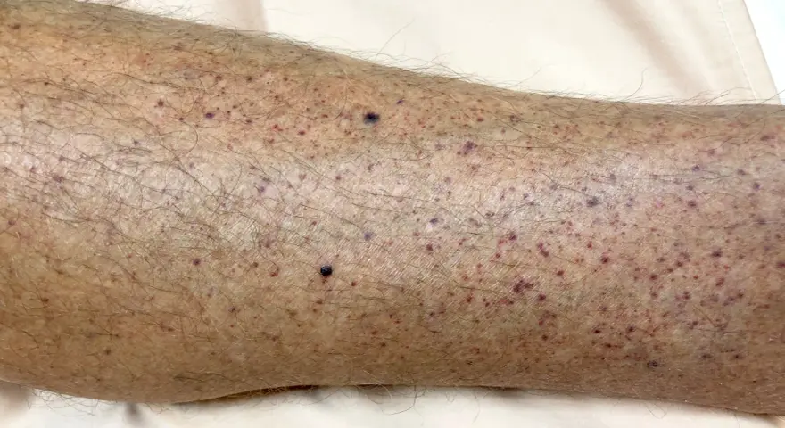 Gambe con numerosi puntini rossi e qualche neo scuro, senza segni di prurito.