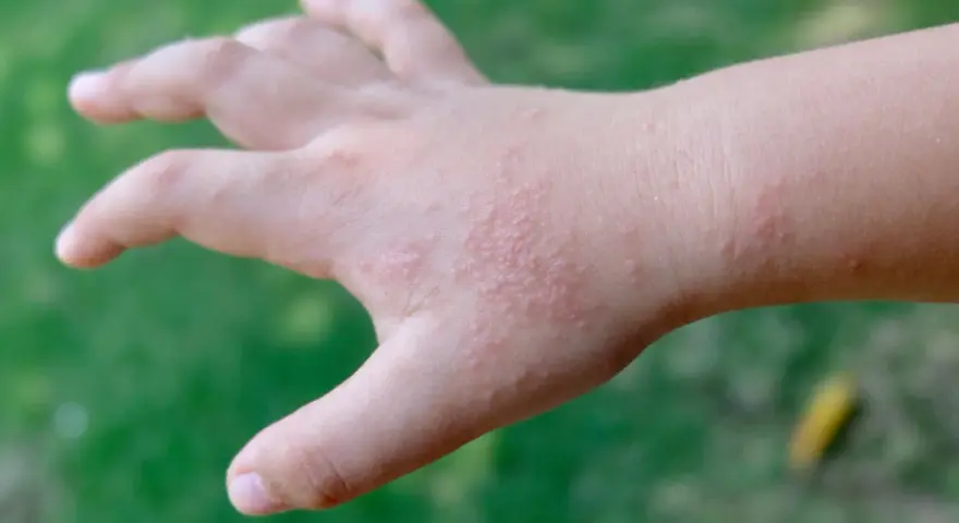 Mano di bambino con puntini rossi sulle dita e sul dorso, senza segni di prurito.