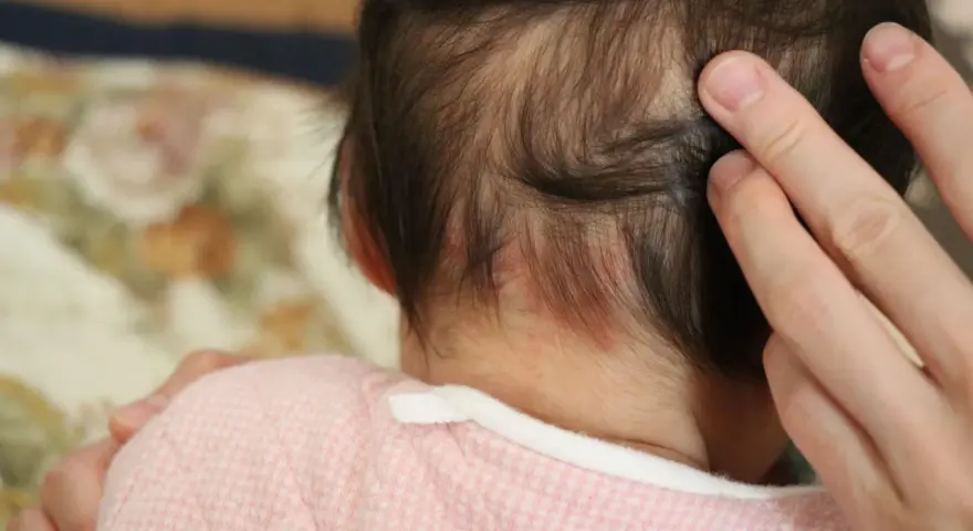 Dita accarezzano la nuca di un neonato, dove si notano delle piccole macchie rosse, un segno del "morso della cicogna".