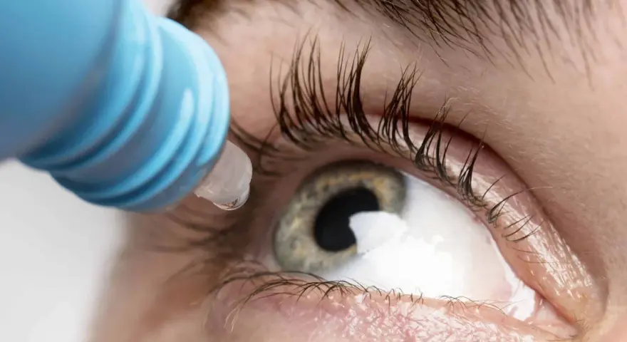 Goccia di collirio antibiotico cade sull'occhio, alleviando un'infezione.