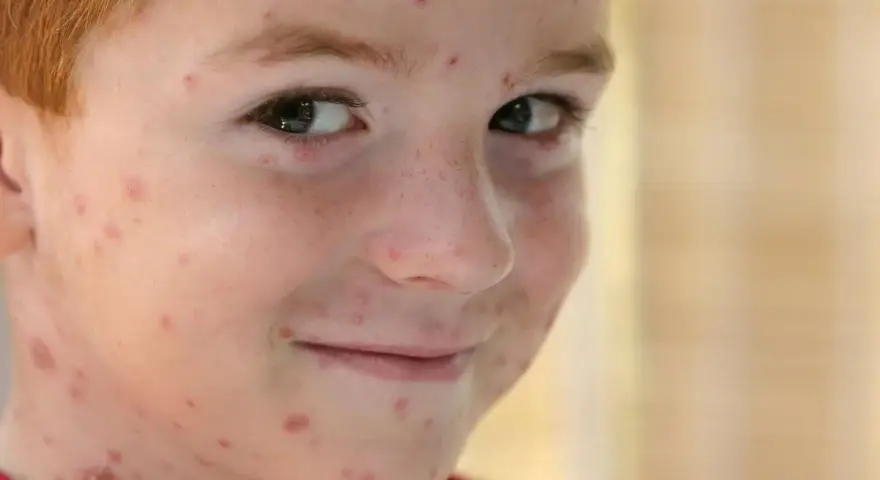 Primo giorno di varicella per questo bimbo con i capelli rossi, il viso e il collo coperti di bolle rosse.