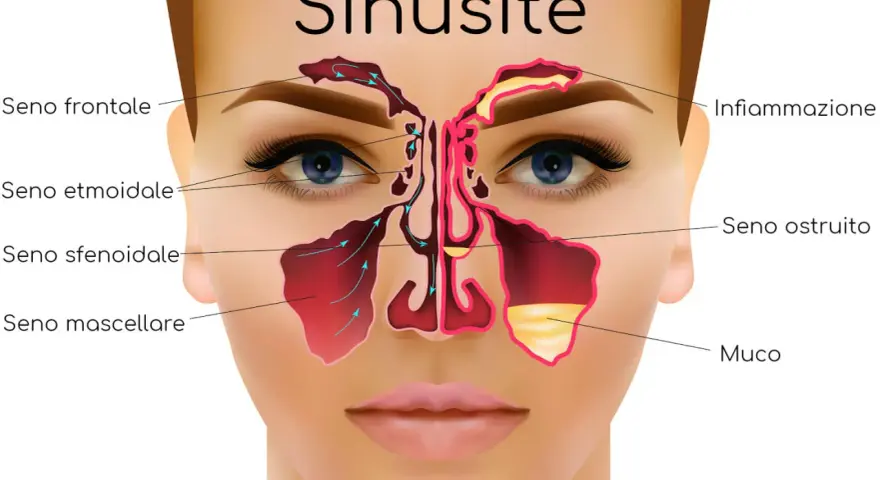 Illustrazione anatomica della sinusite, con seni frontali, etmoidali, sfenoidali e mascellari infiammati e ostruiti da muco. Utile per capire i rimedi.