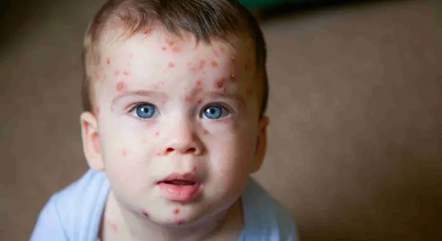 Bambino con eruzioni cutanee tipiche della quinta malattia. La cura è solitamente sintomatica, ma è bene consultare un medico.