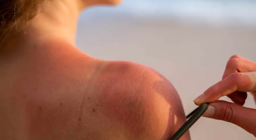 Spalla arrossata dal sole, un tentativo di come abbronzarsi velocemente, ma attenzione alle scottature!