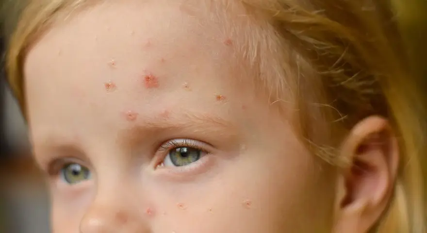 Viso di bambina con eruzioni cutanee, possibili segni di orticaria da streptococco nei bambini.