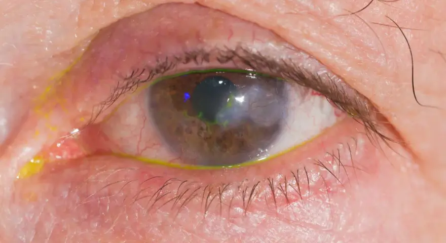 Occhio con segni di herpes, arrossamento e secrezioni giallastre. La cornea presenta un'area opaca e verdeggiante.