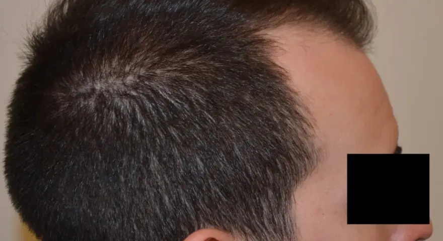 Profilo di un uomo con diradamento dei capelli nella zona della corona, indicativo di alopecia androgenetica.