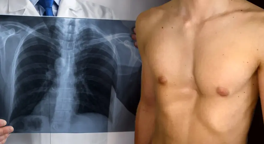 Medico mostra radiografia torace, evidenziando un petto a imbuto.