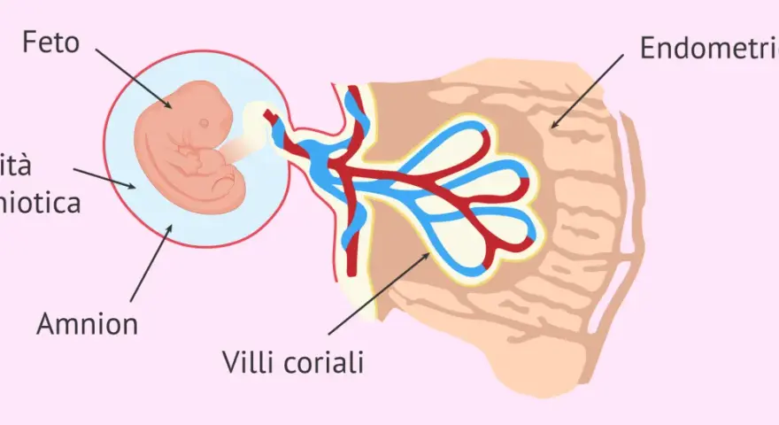 Feto nella cavità amniotica, collegato ai villi coriali nell'endometrio. Il sacco vitellino senza embrione è visibile.