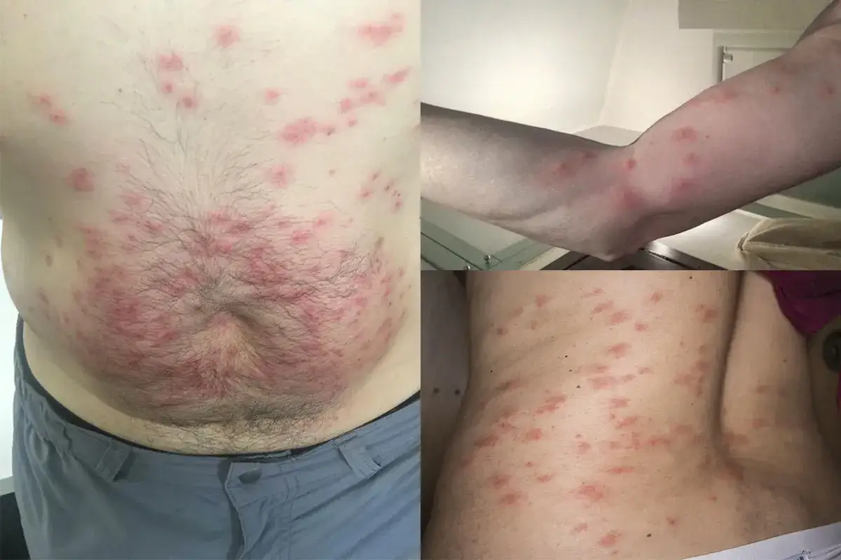 Punture di acari rosse e pruriginose su addome, braccio e schiena.