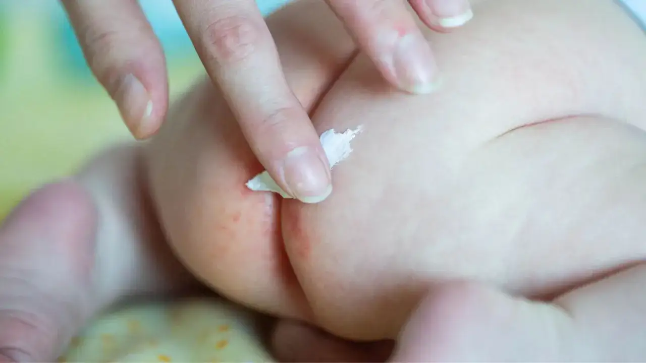 Dito, un dito applica crema su un sederino rosso per cacca acida.