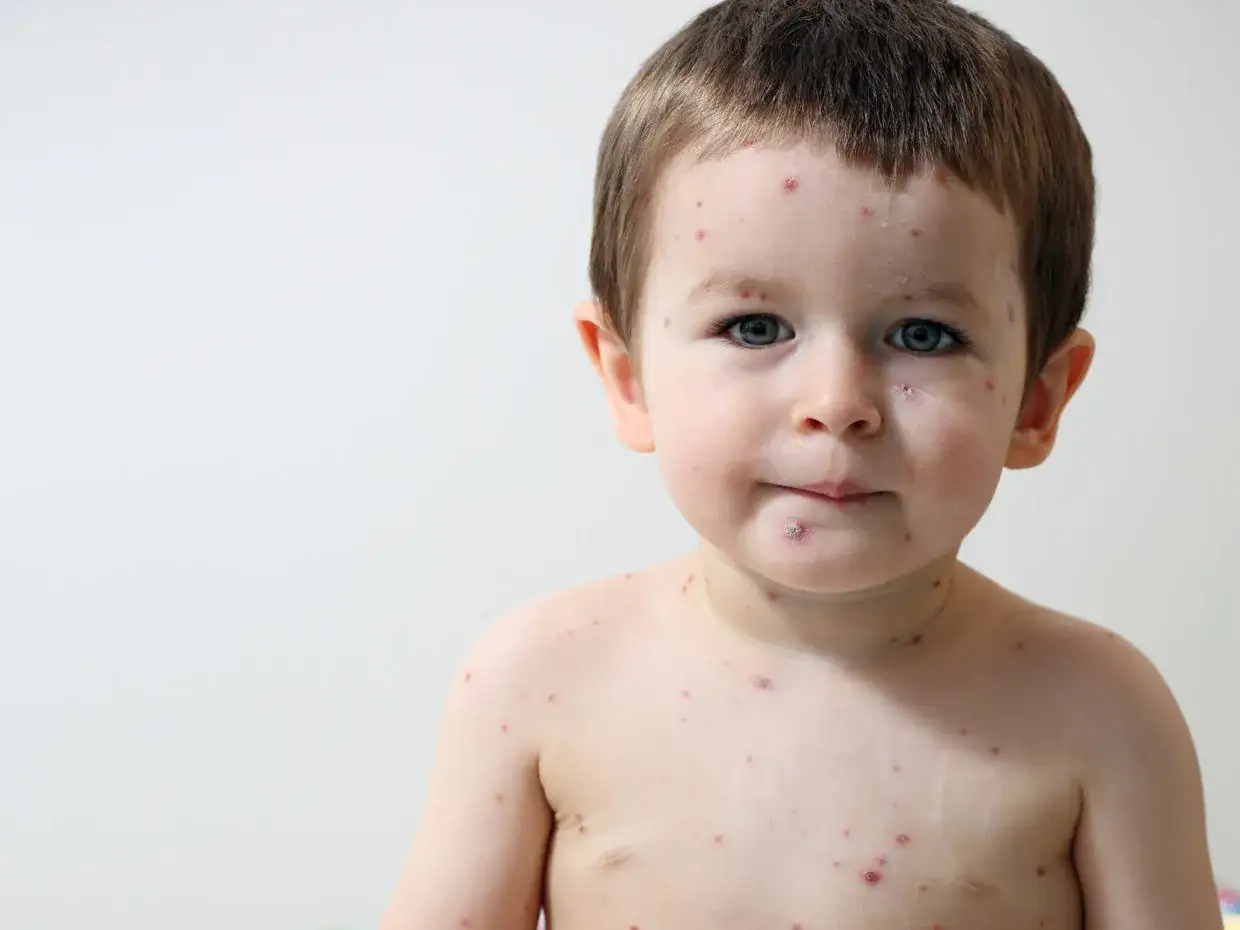 Bambino di 2 anni con puntini rossi intorno alla bocca e sul corpo, forse varicella.