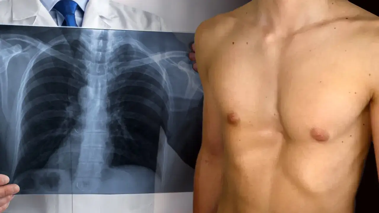 Medico mostra radiografia del torace di un paziente con petto a imbuto, evidenziando la deformit&agrave; sternale.