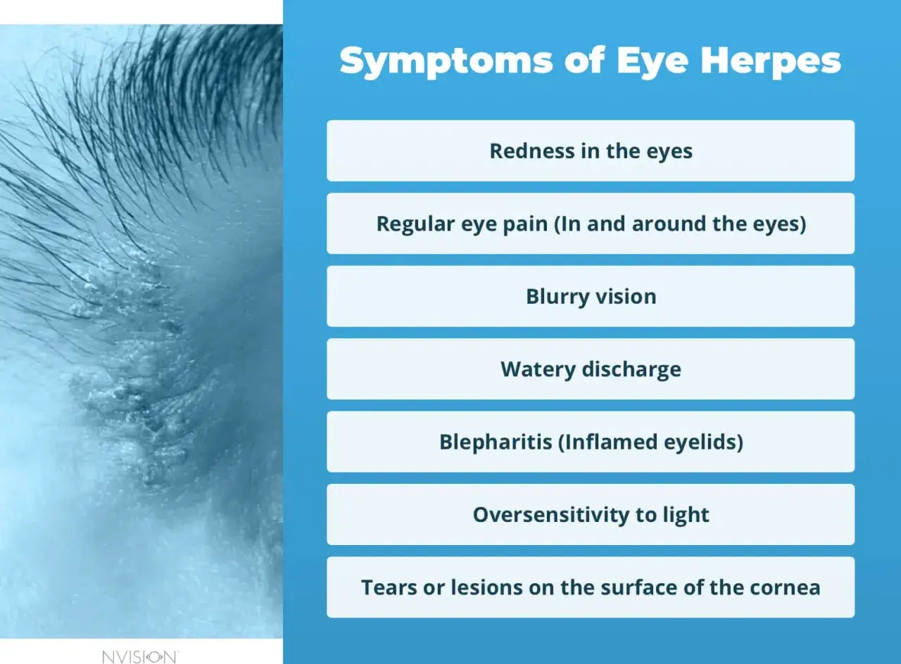 Immagine mostra sintomi di herpes occhio: arrossamento, dolore, visione offuscata, secrezioni, palpebre infiammate e sensibilità alla luce.
