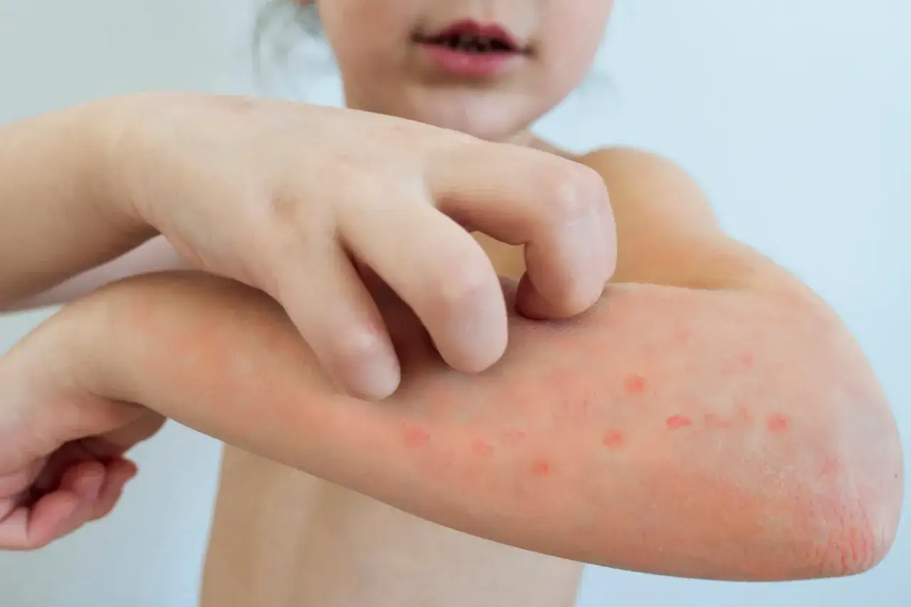 Bambino si gratta il braccio, mostrando le prime bolle di varicella. La pelle &egrave; arrossata e compaiono piccole pustole pruriginose.