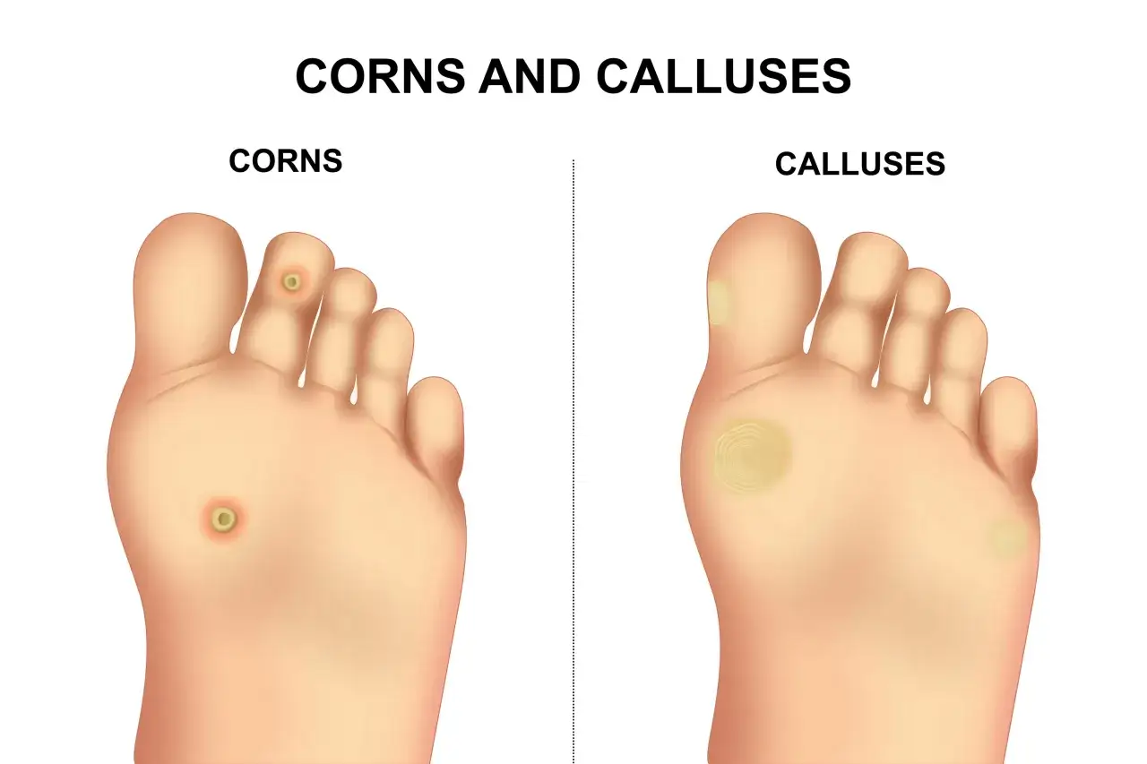 Illustrazione di piedi con calli e duroni. Un occhio di pernice, un tipo di durone, è visibile su un dito.