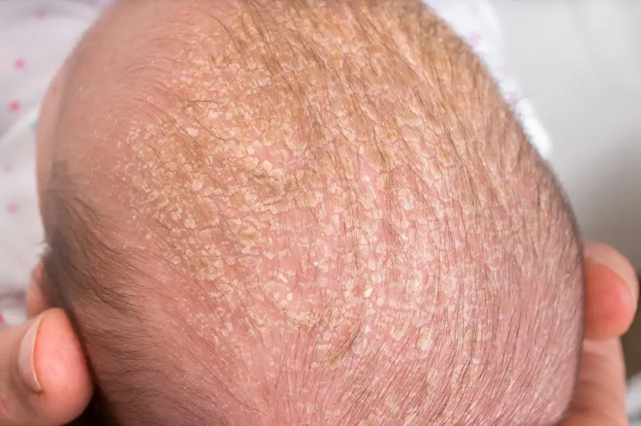 Cute baby's head with flaky skin, a common sign of cro&ucirc;te d'un b&eacute;b&eacute;. The fine hair is visible amidst the patches.