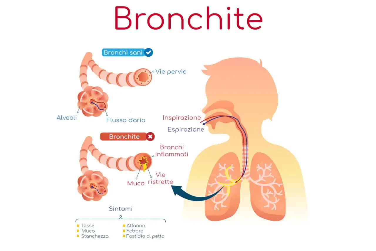 Illustrazione della bronchite: bronchi sani e infiammati, vie aeree ristrette dal muco. Sintomi e flusso d'aria. Potrebbe essere utile un antibiotico per bronchite.