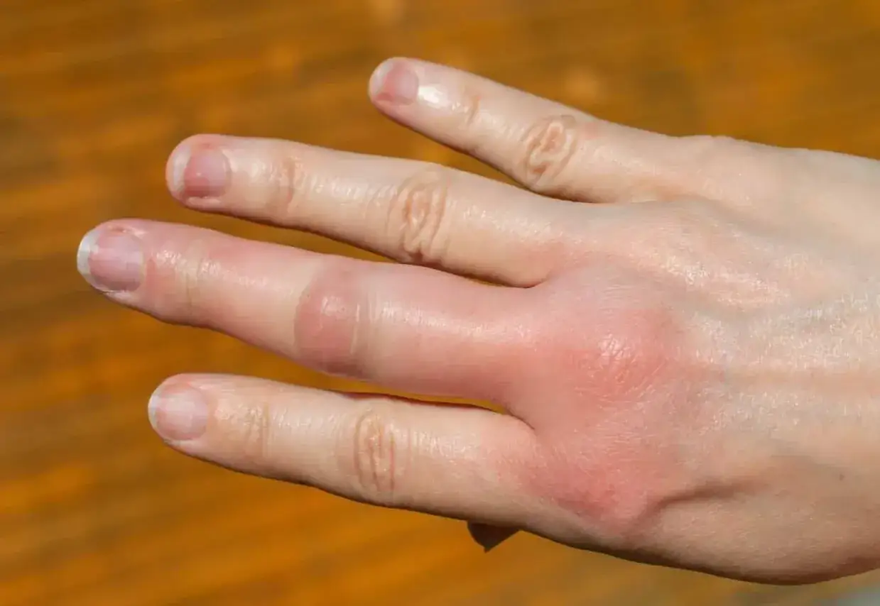 Dito come riconoscerla: gonfiore e arrossamento diffuso sul dorso della mano e sul dito, tipici di una puntura d'ape.