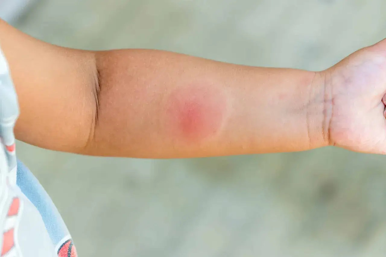 Braccio di bambino con un'area arrossata e gonfia, possibile reazione a punture di ragni.