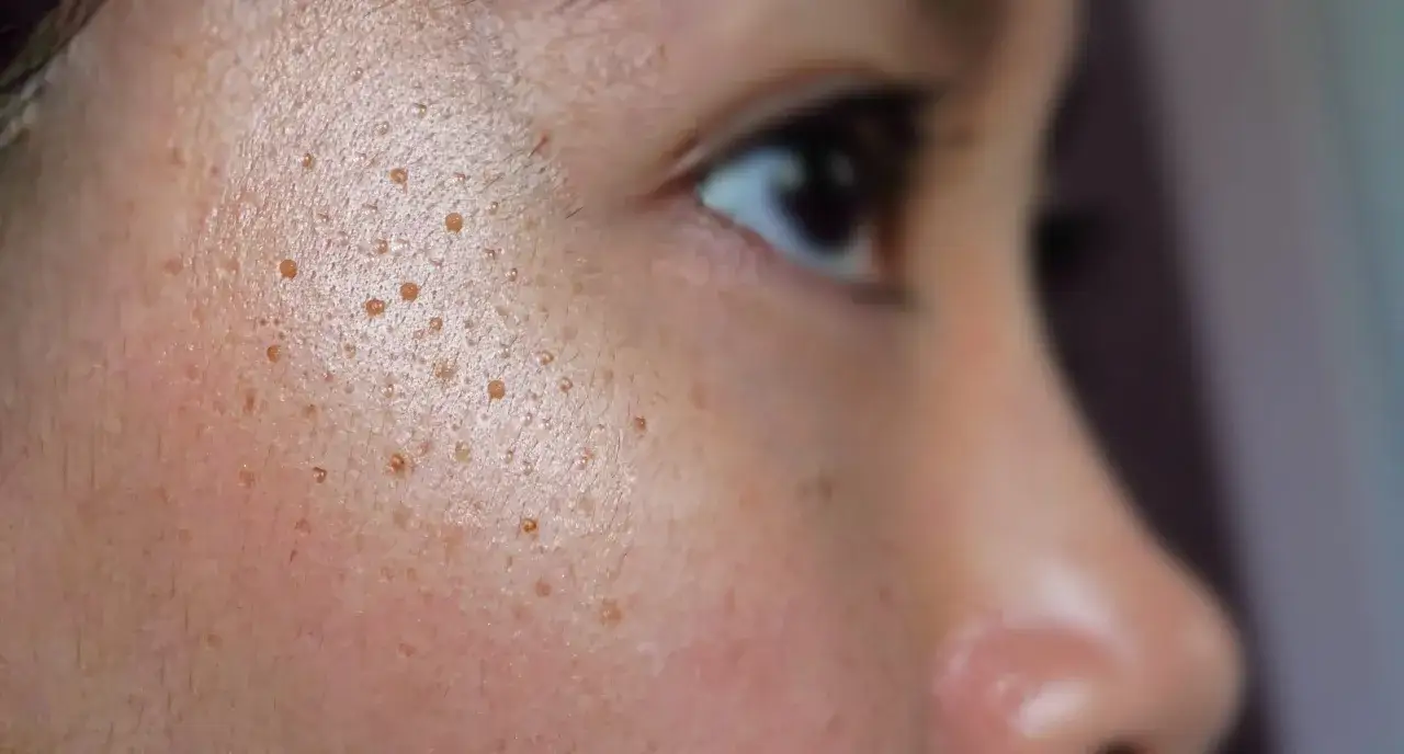 Primo piano del viso con macchie scure sulla pelle, evidenziando la texture e i pori dilatati.