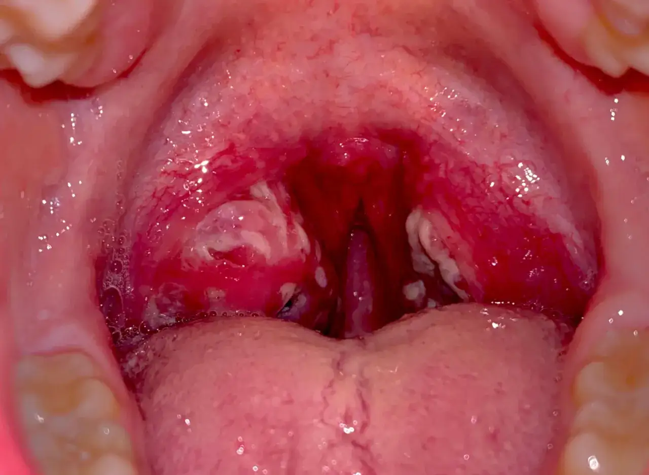 Gola infiammata con placche biancastre, possibile segno di orticaria da streptococco bambini.