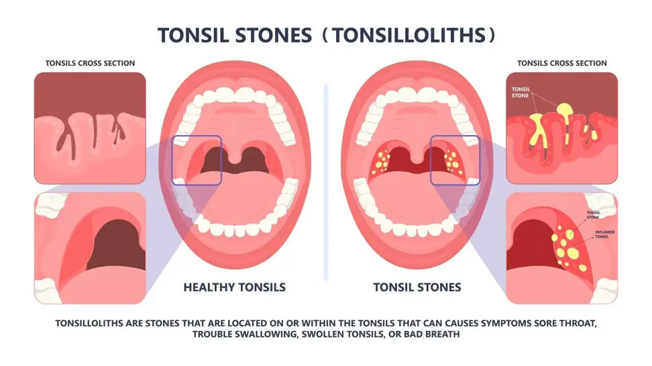 Confronto tra tonsille sane e tonsille con calcoli tonsillari, che appaiono come depositi giallastri.