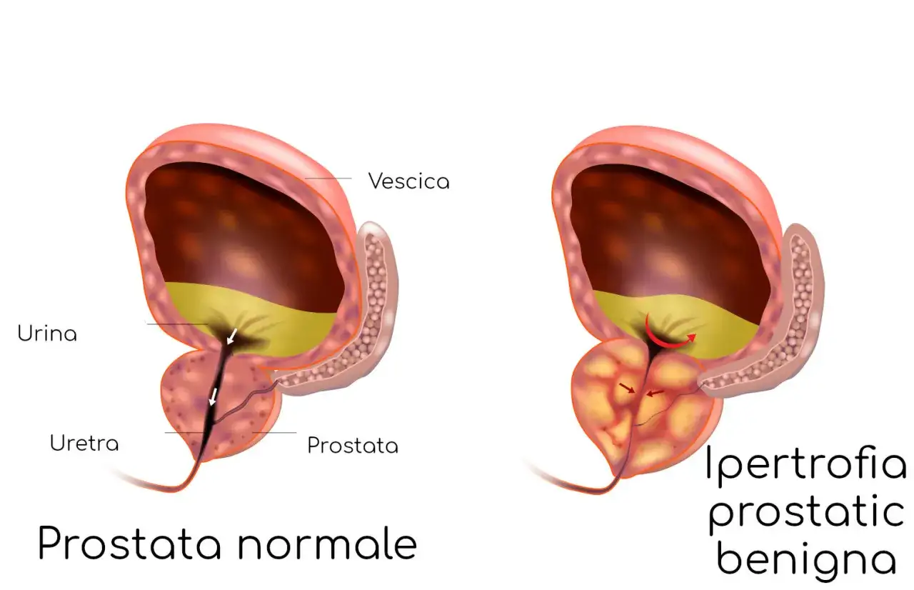 Confronto tra prostata normale e ipertrofia prostatica benigna. Xatral serve a trattare questa condizione, migliorando il flusso urinario.