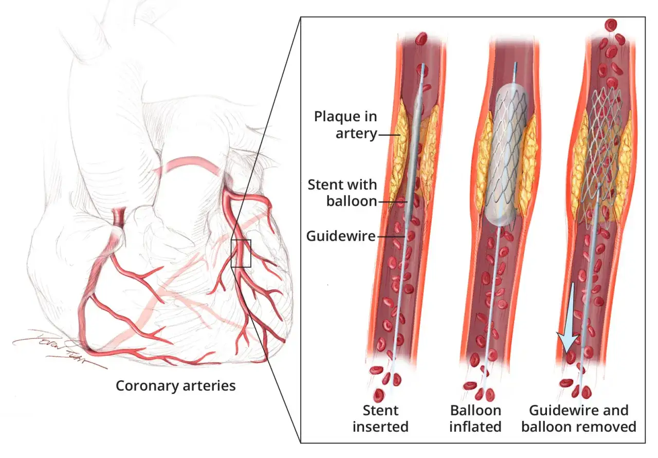 Illustrazione delle arterie coronarie e del posizionamento di uno stent coronarico per aprire un'arteria ostruita da placca.