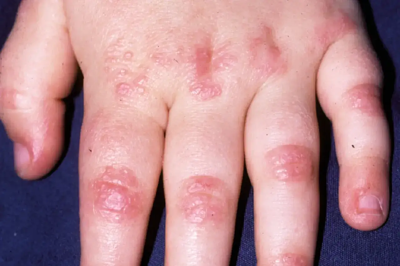 Mani con puntini rossi e vescicole, senza prurito, che interessano le dita e il dorso della mano.