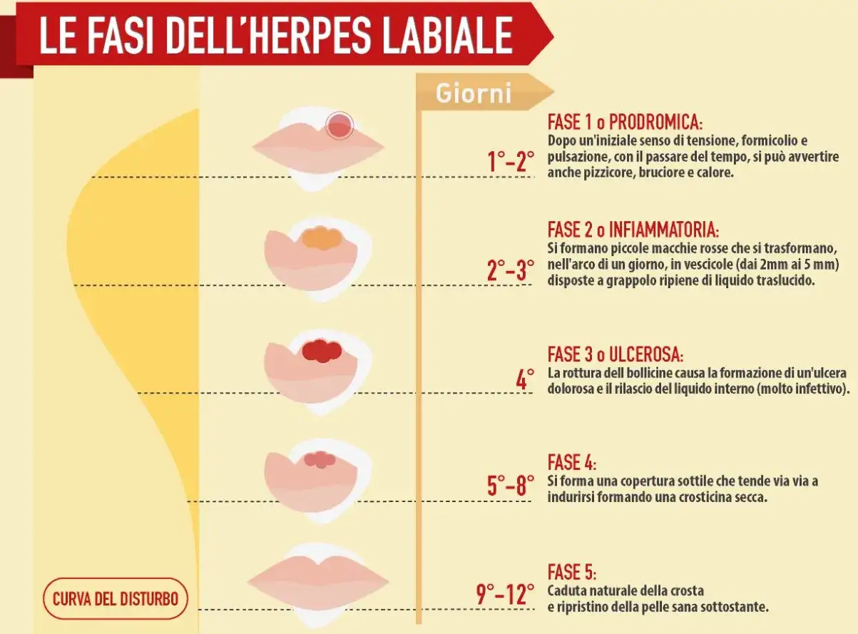 Le fasi dell'herpes labiale: da bolle sulle labbra a crosticina secca.