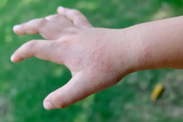 Mano di bambino con puntini rossi sulle dita e sul dorso, senza segni di prurito.