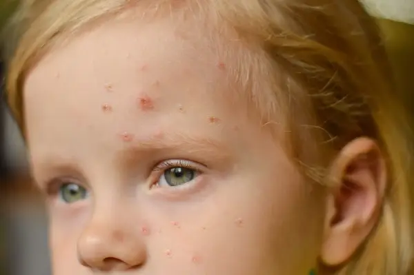 Viso di bambina con eruzioni cutanee, possibili segni di orticaria da streptococco nei bambini.