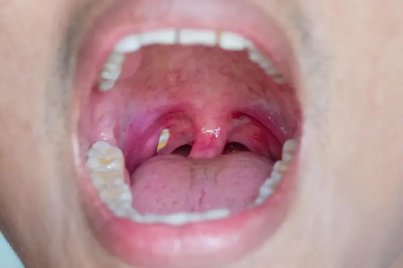 Gola infiammata con tonsille rosse e gonfie, dove si notano evidenti calcoli tonsillari giallastri.